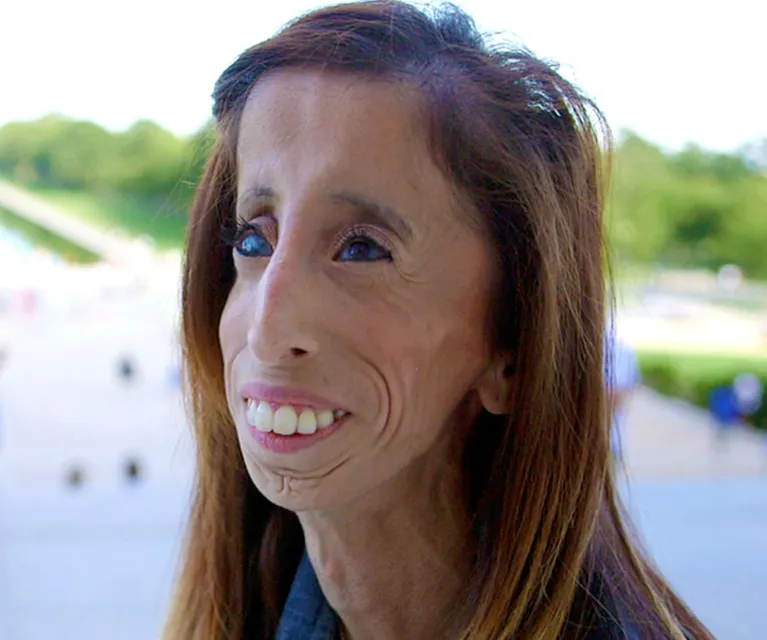 Lizzie Velasquez's Husband, Age, Height, Weight, Net Worth, Career, And More