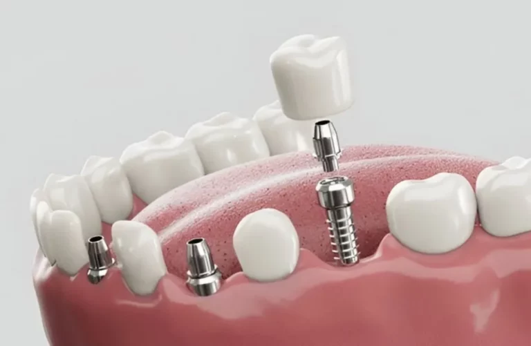Why Dental Implants Are the Ultimate Solution for Tooth Replacement